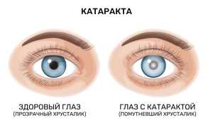 Причины сужения зрачков, методы диагностики и особенности лечения глазных заболеваний