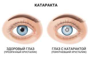 Причины сужения зрачков, методы диагностики и особенности лечения глазных заболеваний