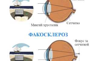 Причины и симптомы факосклероза хрусталика глаза: важная информация для здоровья