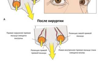 Причины, симптомы и лечение горизонтального нистагма у пациентов
