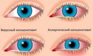 Причины конъюнктивита у ребенка в 2 года, симптомы, лечение и профилактика: важные аспекты здоровья