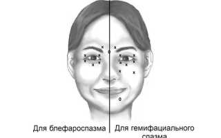 Причины и лечение блефароспазма: важные аспекты и рекомендации