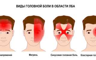 Почему болит голова в области лба и давит на глаза, как лечить неприятный симптом и предотвратить его