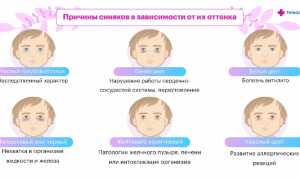 Причины и лечение тёмных кругов под глазами у ребёнка: советы и рекомендации