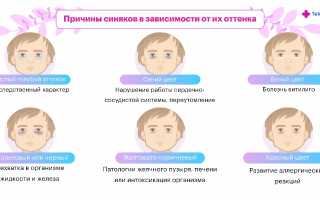 Причины и лечение тёмных кругов под глазами у ребёнка: советы и рекомендации