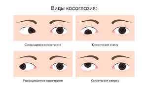 Причины и виды косоглазия у детей, методы лечения и профилактика для здоровья глаз