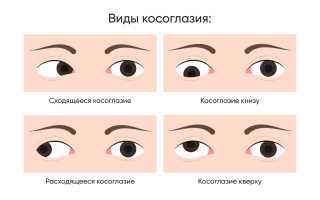 Причины и виды косоглазия у детей, методы лечения и профилактика для здоровья глаз