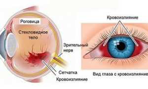 Причины кровоизлияния в сетчатку глаза: важные аспекты и последствия