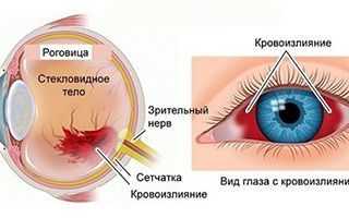 Причины кровоизлияния в сетчатку глаза: важные аспекты и последствия