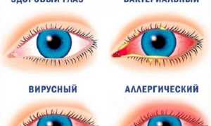 Признаки, симптомы и лечение острого конъюнктивита у взрослых