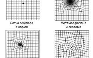 Как правильно проводить тест Амслера для диагностики зрения