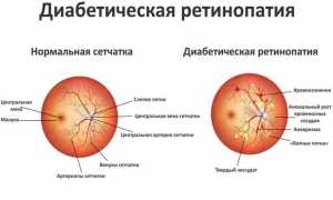 Разновидности, причины, симптомы и лечение ретинопатии сетчатки глаза: полное руководство