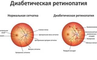 Разновидности, причины, симптомы и лечение ретинопатии сетчатки глаза: полное руководство