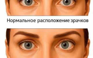 Особенности исправления косоглазия у взрослых: методы и рекомендации