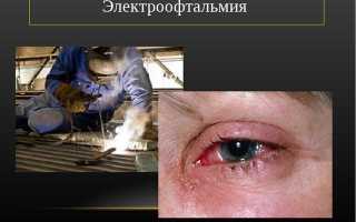 Причины, симптомы и лечение электроофтальмии: важные аспекты