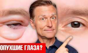 Как без операции убрать мешки под глазами навсегда