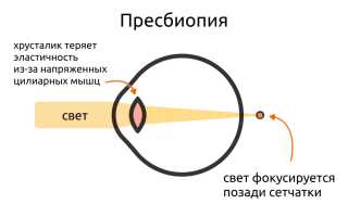 Формы и виды нарушения рефракции глаза: причины и последствия