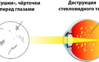 Причины появления мушек перед глазами, диагностика, лечение и профилактика