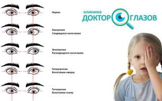 Причины сходящегося косоглазия и методы его коррекции у детей
