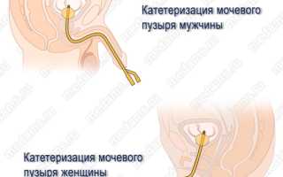 Уретральный катетер — что это и как его устанавливать