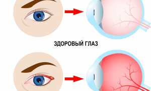 Почему щиплет глаза: причины и советы