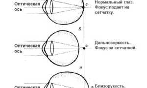 Что такое рефрактометрия глаза и её значение