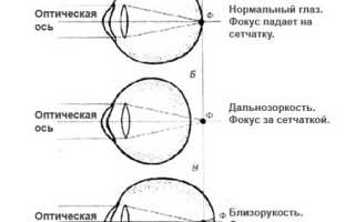 Что такое рефрактометрия глаза и её значение