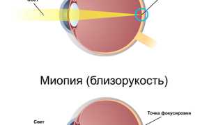 Причины миопии высокой степени, симптомы, лечение и возможные осложнения у пациентов