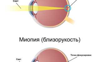 Причины миопии высокой степени, симптомы, лечение и возможные осложнения у пациентов
