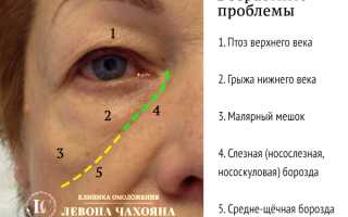Причины и методы лечения отёков под глазами: полезные советы