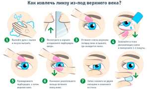 Может ли линза потеряться в глазу: важные аспекты и советы