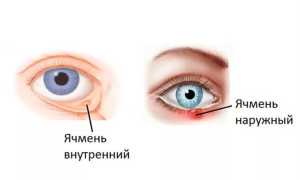 Как лечить в домашних условиях ячмень на глазу быстро и эффективно