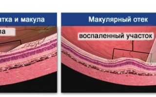 Причины отёка глазного яблока, способы устранения патологии и профилактика