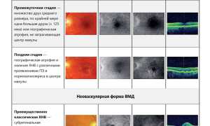 Особенности формирования возрастной макулярной дегенерации у пациентов