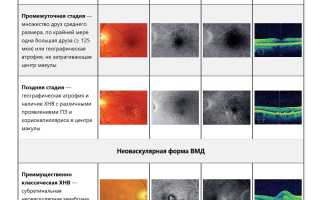 Особенности формирования возрастной макулярной дегенерации у пациентов