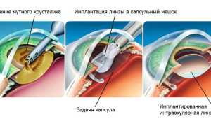 Лечение запущенной катаракты: как быстро нормализовать и восстановить зрение в домашних условиях
