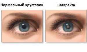 Начальная стадия катаракты: симптомы и лечение
