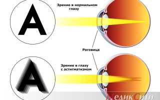 Признаки и методы лечения смешанного астигматизма у взрослых