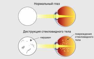 Причины, симптомы, лечение и профилактика деструкции стекловидного тела: важные аспекты здоровья