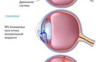 Диагностика и лечение вторичной глаукомы у пациентов