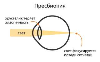 Что такое пресбиопия глаз у взрослых и как с ней справиться