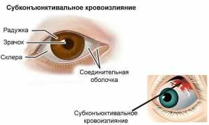 Причины субконъюнктивального кровоизлияния и его лечение: важные аспекты