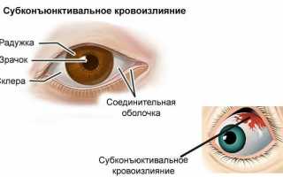 Причины субконъюнктивального кровоизлияния и его лечение: важные аспекты