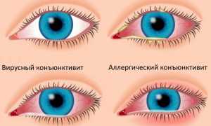 Причины и методы лечения покраснений век у детей: советы и рекомендации