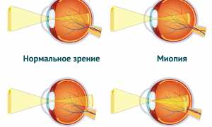 Что такое плохое зрение и его причины