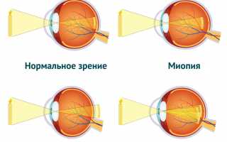 Что такое плохое зрение и его причины