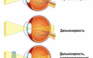 Что такое дальнозоркость и как её корректируют: причины и методы