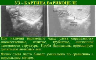 Проба вальсальвы положительная в урологии