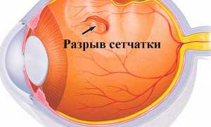 Профилактика и лечение дистрофии сетчатки глаз: важные рекомендации и советы