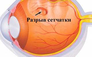 Профилактика и лечение дистрофии сетчатки глаз: важные рекомендации и советы